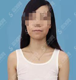 郑州华山医院怎么样?郑州华山医院做的隆胸果好不好