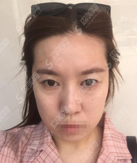 西安哪个整形医院口碑好?西京医院做的双眼皮怎么样?西京医院的医师怎么样?案例分享