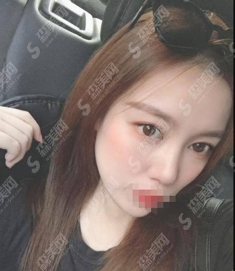 西安哪个整形医院口碑好?西京医院做的双眼皮怎么样?西京医院的医师怎么样?案例分享