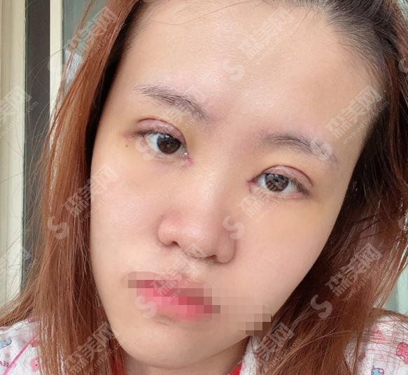 上海美仑是正规医院吗?上海美仑做的双眼皮怎么样?附医师简介及案例分享