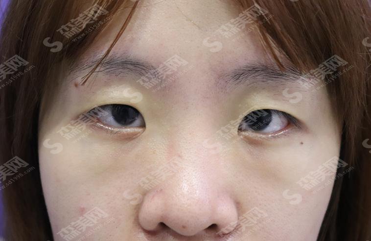 上海美仑是正规医院吗?上海美仑做的双眼皮怎么样?附医师简介及案例分享