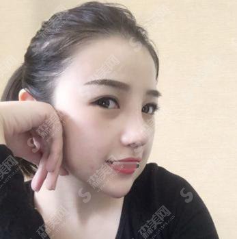 自体软骨隆鼻手术的价格?附隆鼻耳软骨手术案例+前后果对比图