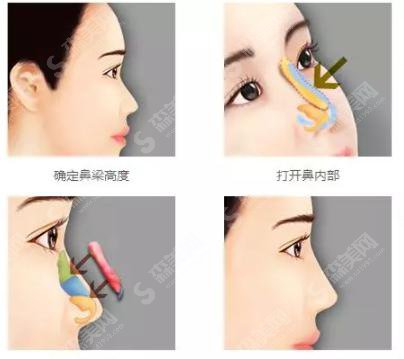 自体软骨隆鼻手术的价格?附隆鼻耳软骨手术案例+前后果对比图