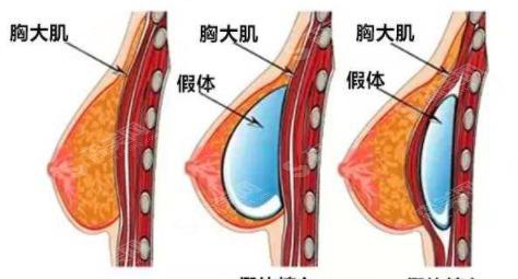 假体隆胸的价格?附假体隆胸案例+前后果对比图