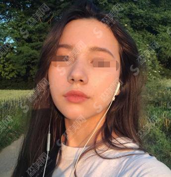 大连达美元辰医疗美容怎么样?达美元辰整形医院做的双眼皮怎么样?附医师介绍及案例分享