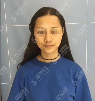 大连达美元辰医疗美容怎么样?达美元辰整形医院做的双眼皮怎么样?附医师介绍及案例分享