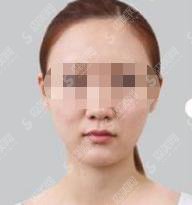 水光补水多少钱？水光补水果好不好？附水光补水介绍及水光补水案例