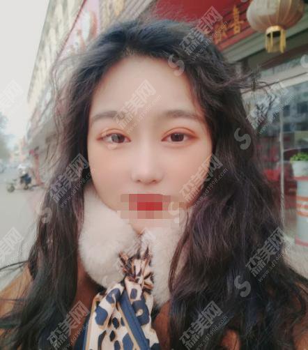 奥雅整形医院怎么样？奥雅整形做的双眼皮怎么样？附医师介绍及案例分享