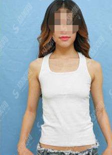 郑大二附院整形科怎么样？郑大二整形科做的隆胸怎么样？附医师介绍及案例分享