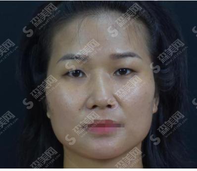 泰安中心医院怎么样？泰安中心做的双眼皮怎么样？附医师介绍及案例分享