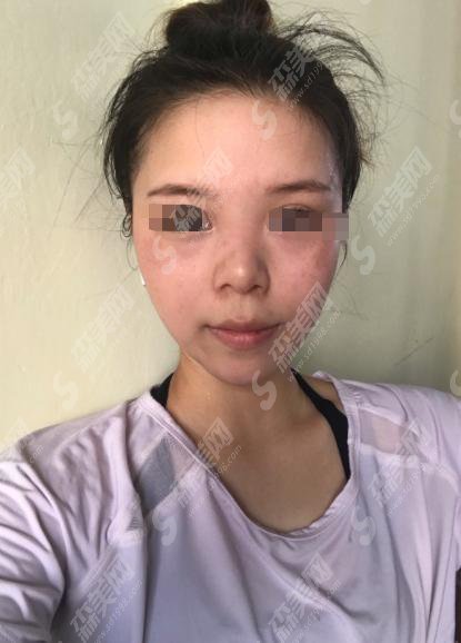 郑州美立方整形医院怎么样?郑州美立方做的鼻子怎么样?附医师介绍及案例分享