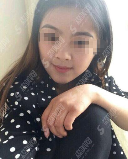 吉大一院整形科怎么样?吉大医院张舵做的鼻子怎么样?附医师介绍及案例分享