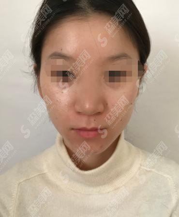 梧州华美整形美容医院怎么样？梧州华美整形医院做的鼻子怎么样？附医师介绍及案例分享