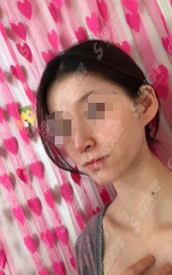 梧州华美整形美容医院怎么样？梧州华美整形医院做的鼻子怎么样？附医师介绍及案例分享