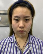 北京同仁整形医院价目表2021，内含面部吸脂的具体果浏览
