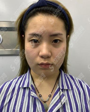 北京同仁整形医院价目表2021,内含面部吸脂的具体果浏览