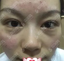 激光去痘痘整形价目表2020,激光祛痘怎么样?内附祛痘较新价格表