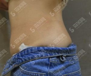 成都八大处整形价目表2020,吸脂瘦身怎么样?内附吸脂较新价目表