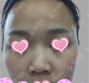 八大处医疗整形医院价格表2020,隆鼻怎么样?内附较新隆鼻价格表