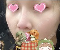 八大处医疗整形医院价格表2020,隆鼻怎么样?内附较新隆鼻价格表