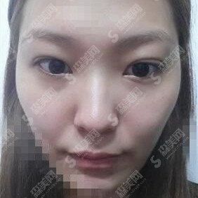 第九医院整形科轮廓整形价目表2020,颧骨整形怎么样？内附颧骨整形的恢复过程图