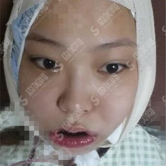 第九医院整形科轮廓整形价目表2020,颧骨整形怎么样？内附颧骨整形的恢复过程图