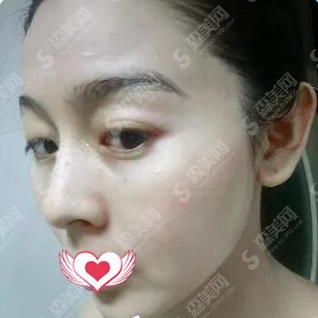 光子嫩肤美白价目表2020,光子嫩肤怎么样?内附较新光子嫩肤价目表
