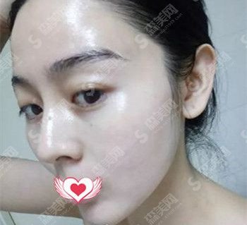 光子嫩肤美白价目表2020,光子嫩肤怎么样?内附较新光子嫩肤价目表