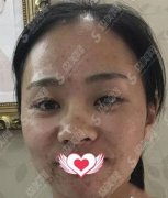 光子嫩肤美白多少钱？光子美白怎么样？附上光子美白的果恢复图