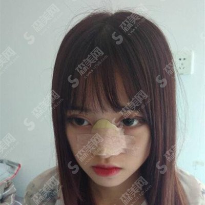 北京八大处整形价目表一览2020(图),整形专家杨明勇怎么样?附带隆鼻案例果图