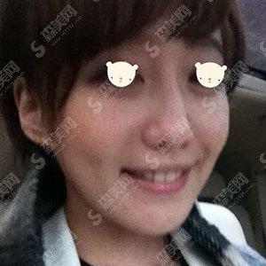 美白牙齿价目表2020,牙齿美白好不好?牙齿美白的恢复果图