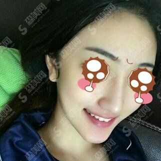 鼻部手术整形价格一览表（图）曝光,鼻整形的优势介绍&鼻整形的恢复果图