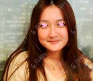 注射瘦脸注射整形价目表2020,注射瘦脸注射怎么样?注射瘦脸注射的恢复果图