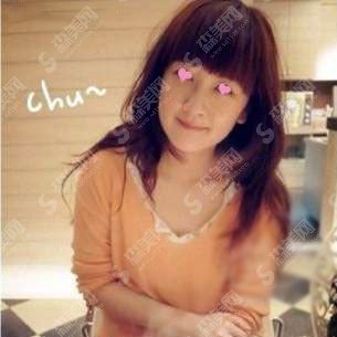 注射瘦脸注射整形价目表2020,注射瘦脸注射怎么样?注射瘦脸注射的恢复果图