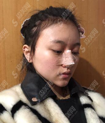 上海九院价格表2021,附鼻部综合案例前后对比照片