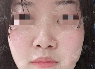 鼻子综合整形价目表2020,鼻子综合整形的优势?内附鼻子综合整形的恢复对比图