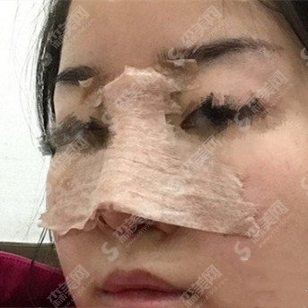 鼻子综合整形价目表2020,鼻子综合整形的优势?内附鼻子综合整形的恢复对比图