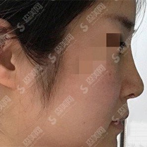 鼻子综合整形价目表2020,鼻子综合整形的优势?内附鼻子综合整形的恢复对比图