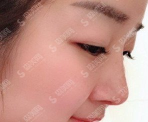 鼻子综合整形价目表2020,鼻子综合整形的优势?内附鼻子综合整形的恢复对比图