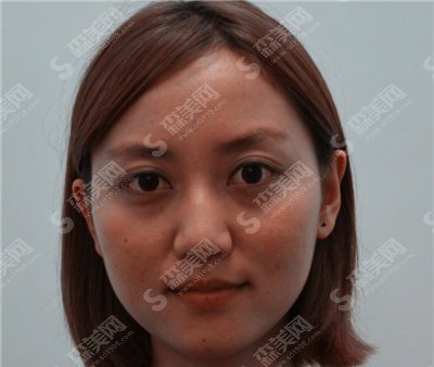 激光嫩肤治疗价目表2020,激光嫩肤怎么样?内附激光嫩肤较新的价目表