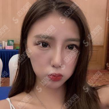 池州立新整形美容医院价目表2021,内含程立新鼻部整形案例果图