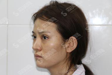 北京八大处整形美容价目表2021,内含自体脂肪全脸填充具体果图