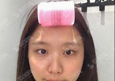 北京京民医院整形价目表2021，内含郭建玲割双眼皮的具体果图浏览