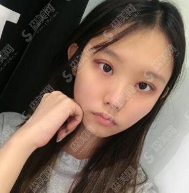 北京京民医院整形价目表2021，内含郭建玲割双眼皮的具体果图浏览