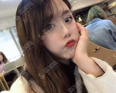 北京京民医院整形价目表2021，内含郭建玲割双眼皮的具体果图浏览