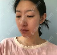 激光嫩肤的整形价目表2020,激光嫩肤是怎么样的?内含激光嫩肤的较近价目表