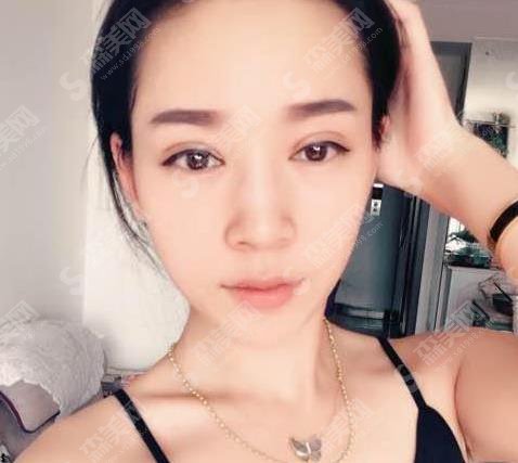 上海九院价目表2021，内含割双眼皮案例近期想过图对比