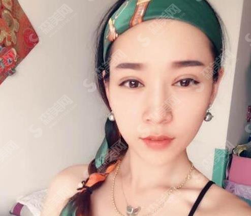 上海九院价目表2021，内含割双眼皮案例近期想过图对比