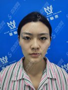 脸部自体脂肪填充价格表2020,脸部自体脂肪填充怎么样？内附自体脂肪填充的果恢复图
