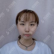 割双眼皮的价目一览表2020,割双眼皮怎么样？内含个双眼皮的手术果恢复图